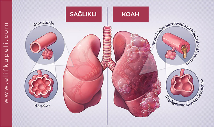 COPD Treatment in Ankara, Turkey
