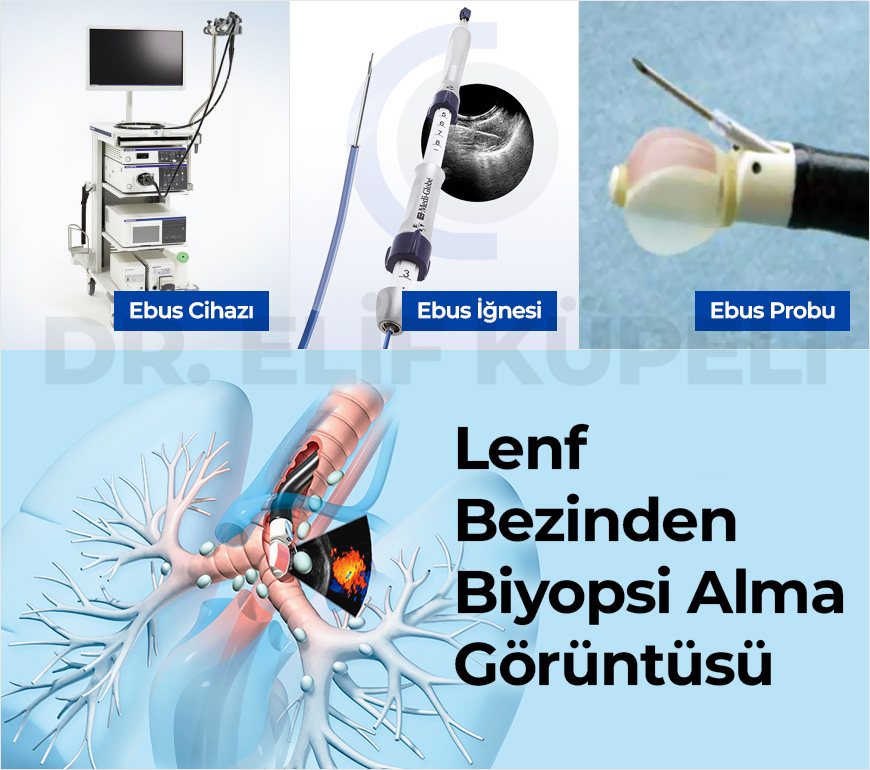 Endobronşiyal Ultrasonografi (EBUS)