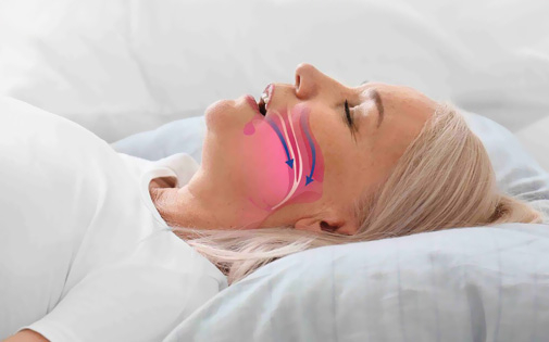Snoring and Sleep Apnea